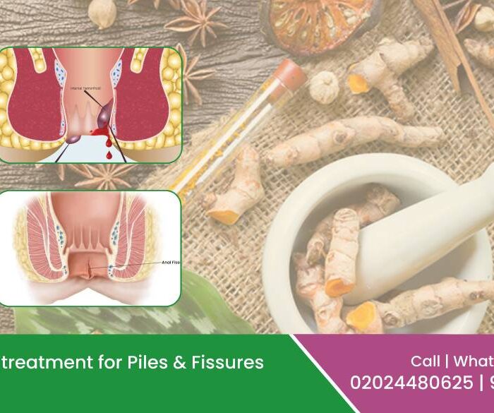 Ayurvedic Treatment For Piles & Fissures