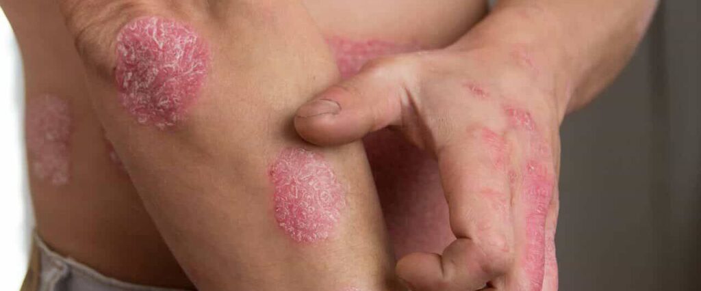 Ayurvedic Psoriasis Treatment in Mumbai