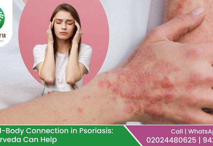 Psoriasis