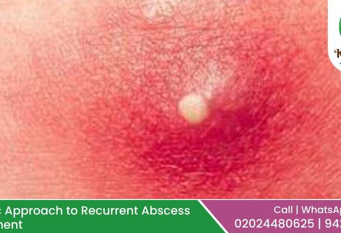 Recurrent Abscess