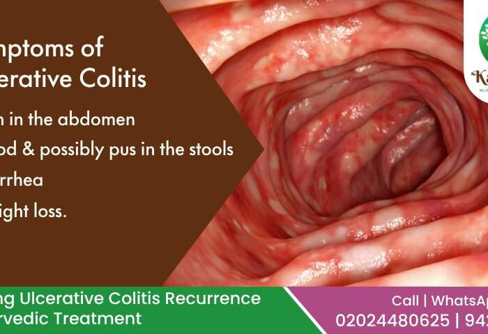 Preventing Ulcerative Colitis
