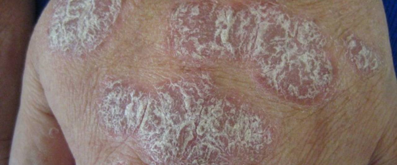 Ayurvedic Treatment For Plaque Psoriasis