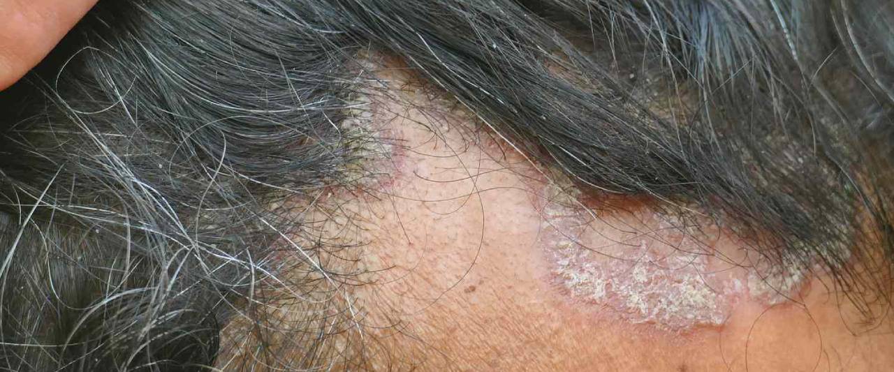 Ayurvedic Treatment For Scalp Psoriasis