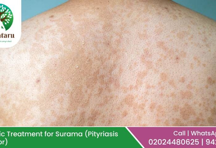 Ayurvedic Treatment for Surama (Pityriasis Versicolor): Causes, Symptoms & Natural Remedies