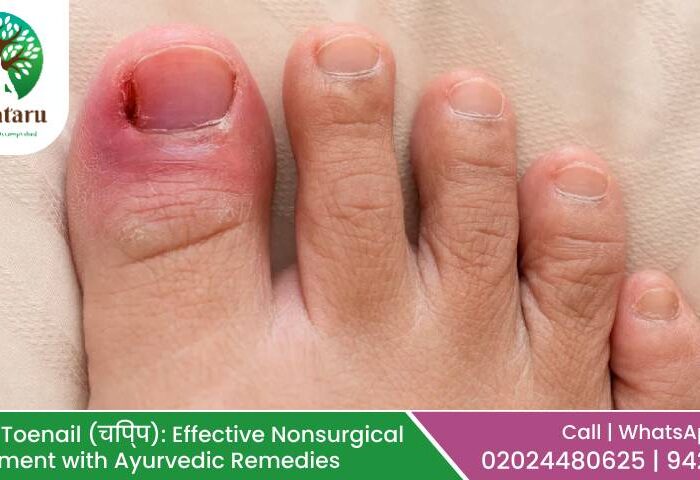 Ingrown Toenail (चिप्प): Effective Nonsurgical Management with Ayurvedic Remedies