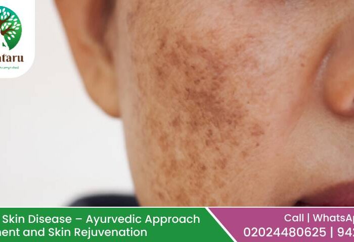 Melasma ( व्यंग in Sankrit, वांग in Marathi) Skin Disease – Ayurvedic Approach to Treatment and Skin Rejuvenation
