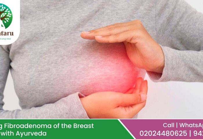 Managing Fibroadenoma of the Breast Naturally with Ayurveda: Causes, Symptoms, and Effective Treatments