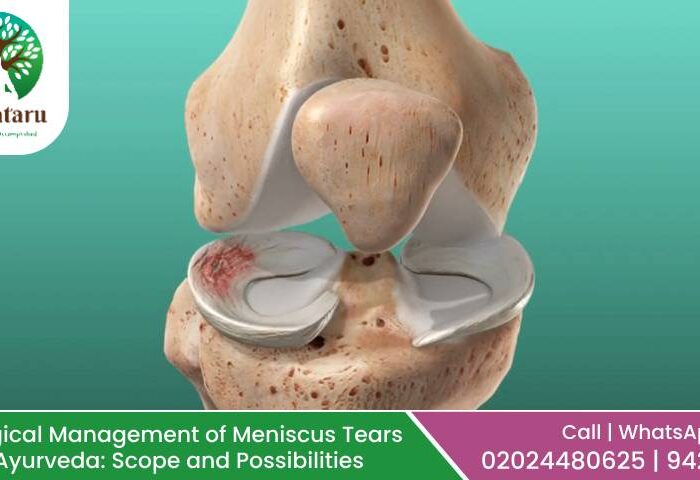 Non-Surgical Management of Meniscus Tears Through Ayurveda: Scope and Possibilities