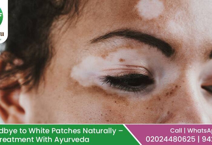 Vitiligo Treatment in Ayurveda